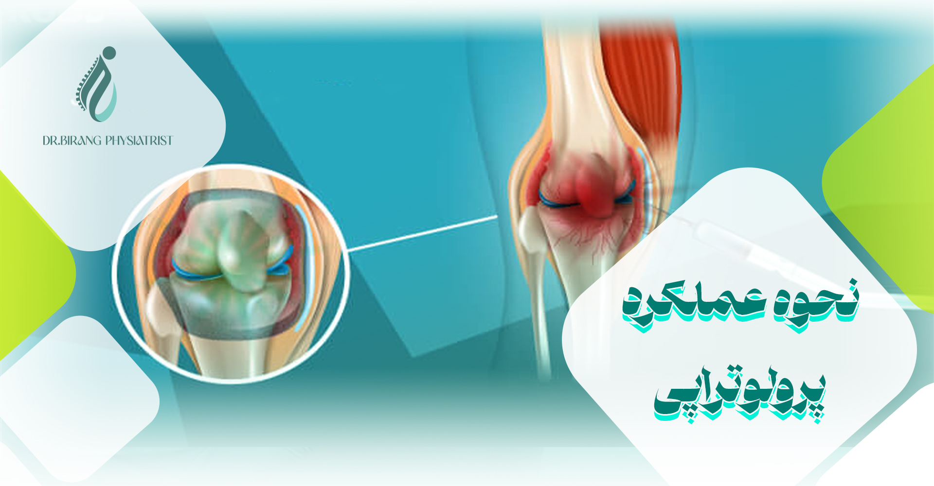 نحوه عملکرد پرولوتراپی