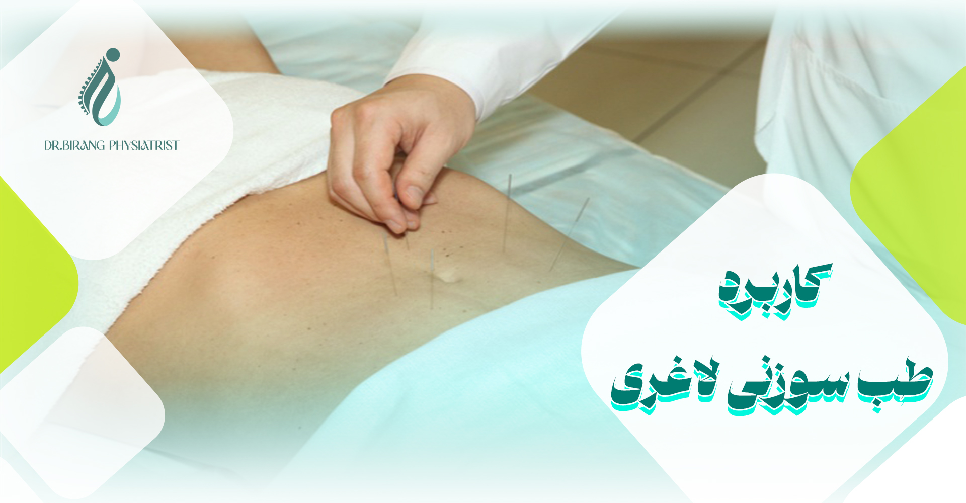 کاربرد طب سوزنی برای لاغری شکم و پهلو
