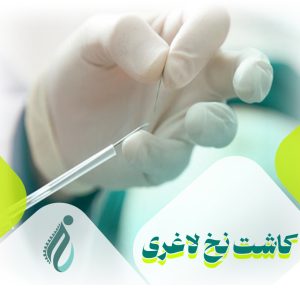 امبدینگ (کاشت نخ لاغری) در کرج