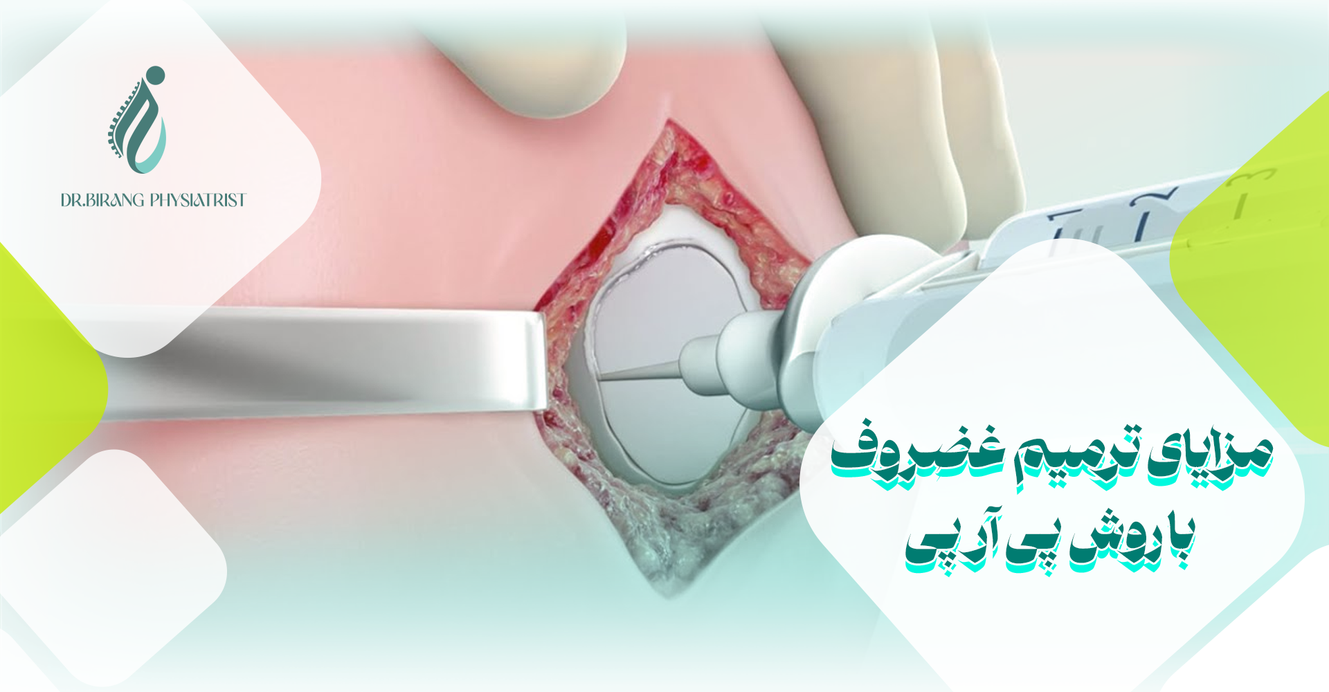 مزایای ترمیم غضروف با روش پی آر پی