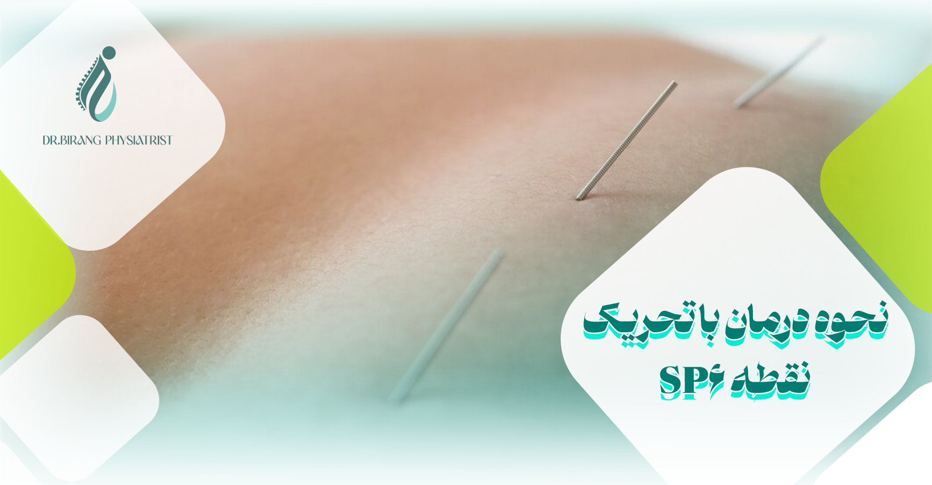 نحوه درمان با تحریک نقطه SP6