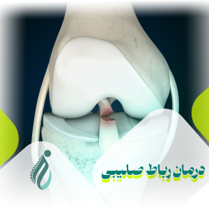 روش های درمان رباط صلیبی